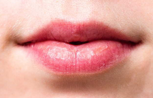 Cheilitis Unveiled A Comprehensive Guide